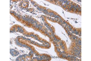 Immunohistochemistry of Human liver cancer using SIGLEC6 Polyclonal Antibody at dilution of 1:60 (SIGLEC6 抗体)