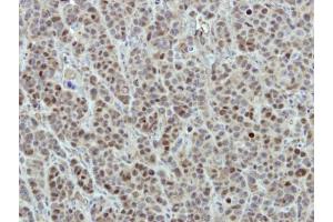 IHC-P Image Immunohistochemical analysis of paraffin-embedded MCF7 xenograft, using DDX56, antibody at 1:500 dilution. (DDX56 抗体  (Center))