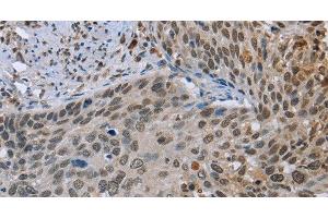 Immunohistochemistry of paraffin-embedded Human cervical cancer tissue using NMT1 Polyclonal Antibody at dilution 1:45 (NMT1 抗体)