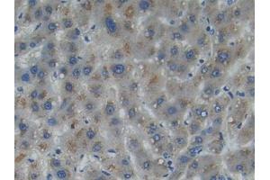 DAB staining on IHC-P; Samples: Human Liver cancer Tissue (Myosin IA 抗体  (AA 781-1043))
