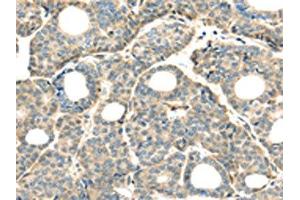 The image on the left is immunohistochemistry of paraffin-embedded Human thyroid cancer tissue using ABIN7128031(THAP2 Antibody) at dilution 1/20, on the right is treated with fusion protein. (THAP2 抗体)
