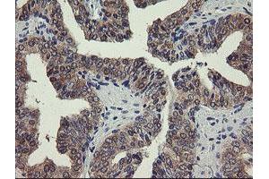 Immunohistochemical staining of paraffin-embedded Human prostate tissue using anti-PGM3 mouse monoclonal antibody. (Phosphoglucomutase 3 抗体)
