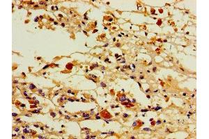 Immunohistochemistry of paraffin-embedded human melanoma using ABIN7164848 at dilution of 1:100 (PTGIS 抗体  (AA 113-199))