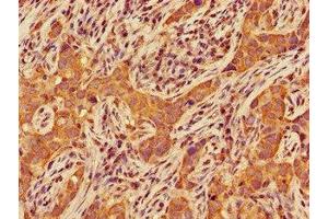 Immunohistochemistry of paraffin-embedded human pancreatic cancer using ABIN7147455 at dilution of 1:100 (CERK 抗体  (AA 212-478))