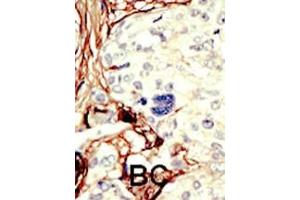 Formalin-fixed and paraffin-embedded human cancer tissue reacted with the primary antibody, which was peroxidase-conjugated to the secondary antibody, followed by DAB staining. (LKB1 抗体  (C-Term))