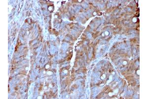 Formalin-fixed, paraffin-embedded human Colon Carcinoma stained with MerTK Mouse Monoclonal Antibody (MERTK/3022). (MERTK 抗体  (AA 55-148))