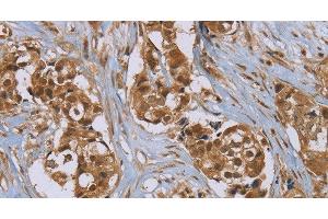 Immunohistochemistry of paraffin-embedded Human breast cancer using PUS10 Polyclonal Antibody at dilution of 1:45 (PUS10 抗体)