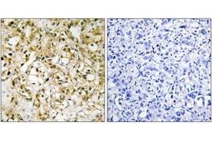 Immunohistochemistry analysis of paraffin-embedded human liver carcinoma tissue, using TFAM Antibody. (TFAM 抗体  (AA 131-180))