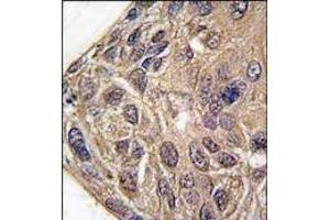 Formalin-fixed and paraffin-embedded human lung carcinoma tissue reacted with YARS antibody (C-term), which was peroxidase-conjugated to the secondary antibody, followed by DAB staining. (YARS 抗体  (C-Term))