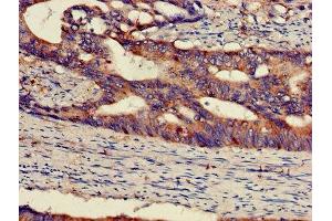 IHC image of ABIN7150697 diluted at 1:300 and staining in paraffin-embedded human colon cancer performed on a Leica BondTM system. (MEK1 抗体  (AA 2-79))