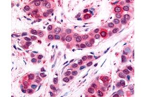 Anti-UCHL3 antibody IHC of human Breast, Carcinoma. (UCHL3 抗体  (C-Term))