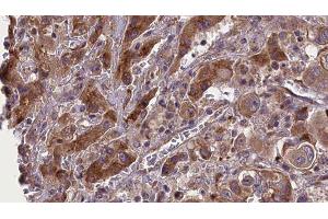ABIN6277689 at 1/100 staining Human liver cancer tissue by IHC-P. (BMPR2 抗体  (Internal Region))