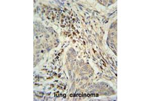 C19orf50 Antibody (Center) immunohistochemistry analysis in formalin fixed and paraffin embedded human lung carcinoma followed by peroxidase conjugation of the secondary antibody and DAB staining. (C19orf50 抗体  (Middle Region))