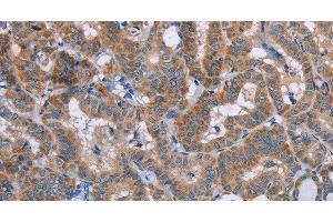 Immunohistochemistry of paraffin-embedded Human thyroid cancer using POMT1 Polyclonal Antibody at dilution of 1:50 (POMT1 抗体)