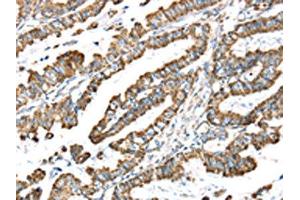 The image on the left is immunohistochemistry of paraffin-embedded Human esophagus cancer tissue using ABIN7191329(LTB4R2 Antibody) at dilution 1/20, on the right is treated with synthetic peptide. (LTB4R2 抗体)