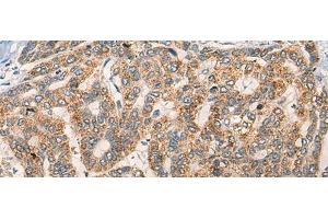 Immunohistochemistry of paraffin-embedded Human liver cancer tissue using NLGN1 Polyclonal Antibody at dilution of 1:50(x200) (Neuroligin 1 抗体)