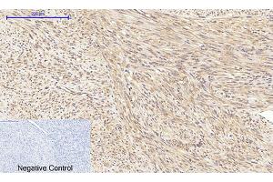 Immunohistochemical analysis of paraffin-embedded human uterus cancer tissue.