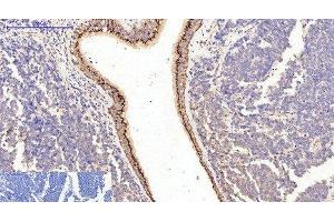 Immunohistochemistry of paraffin-embedded Human lung cancer tissue using COL1A1 Monoclonal Antibody at dilution of 1:200. (COL1A1 抗体)