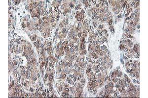 Immunohistochemical staining of paraffin-embedded Carcinoma of Human liver tissue using anti-RPN1 mouse monoclonal antibody. (RPN1 抗体)
