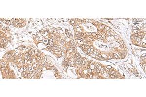 Immunohistochemistry of paraffin-embedded Human gastric cancer tissue using SEC11A Polyclonal Antibody at dilution of 1:45(x200) (SEC11A 抗体)