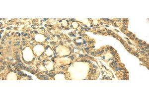 Immunohistochemistry of paraffin-embedded Human thyroid cancer using SDHA Polyclonal Antibody at dilution of 1/40 (SDHA 抗体)