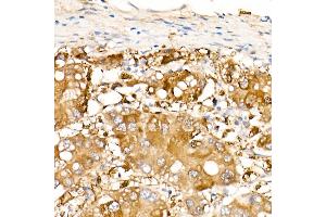 Immunohistochemistry of paraffin-embedded Human liver cancer using  antibody (ABIN7265531) at dilution of 400 (40x lens).