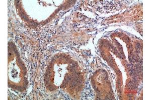Immunohistochemical analysis of paraffin-embedded human-colon-cancer, antibody was diluted at 1:200 (PDGFC 抗体  (AA 61-110))