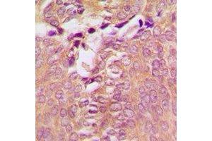 Immunohistochemical analysis of DAP Kinase 1 staining in human breast cancer formalin fixed paraffin embedded tissue section. (DAP Kinase 1 抗体)