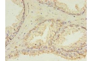 Immunohistochemistry of paraffin-embedded human prostate cancer using ABIN7154764 at dilution of 1:100 (HDDC3 抗体  (AA 2-140))