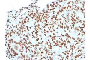 Formalin-fixed, paraffin-embedded human Breast Carcinoma stained with BMI1 Mouse Monoclonal Antibody (BMI1/2823). (BMI1 抗体  (AA 142-326))