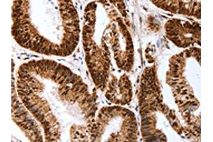 The image on the left is immunohistochemistry of paraffin-embedded Human colon cancer tissue using ABIN7193127(Map2 Antibody) at dilution 1/40, on the right is treated with synthetic peptide. (MAP2 抗体)