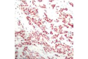 Immunohistochemistry of paraffin-embedded human breast carcinoma using Phospho-NFKB2-S866 antibody (ABIN2988214). (NFKB2 抗体  (pSer866))