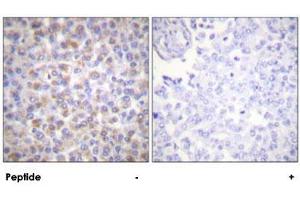 Immunohistochemical analysis of paraffin-embedded human breast carcinoma tissue using YWHAZ polyclonal antibody . (14-3-3 zeta 抗体)