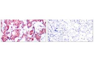 Immunohistochemical analysis of paraffin-embedded human breast carcinoma tissue using GATA-1 (phospho-Ser142) antibody (E011041). (GATA1 抗体  (pSer142))