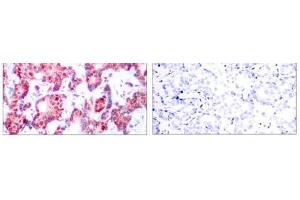 Immunohistochemical analysis of paraffin-embedded human breast carcinoma tissue using GATA-1 (phospho-Ser142) antibody (E011041). (GATA1 抗体  (pSer142))