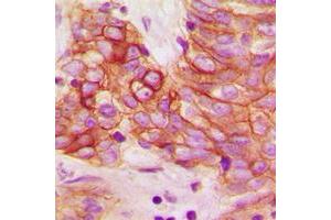 Immunohistochemical analysis of Calmodulin (pT80/S82) staining in human breast cancer formalin fixed paraffin embedded tissue section. (Calmodulin 1 抗体  (pSer80, pSer82))