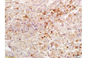 Formalin-fixed and paraffin embedded human lung carcinoma labeled with Rabbit Anti AKR1A1 Polyclonal Antibody, Unconjugated (ABIN872733) at 1:200 followed by conjugation to the secondary antibody and DAB staining (AKR1A1 抗体  (AA 53-130))