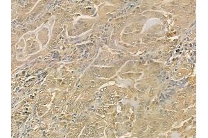ABIN6265823 and ABIN6276506 at 1/100 staining human lung adenocarcinoma by IHC-P. (Thymidine Phosphorylase 抗体  (N-Term))