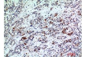 Immunohistochemistry (IHC) analysis of paraffin-embedded Human Breast Cancer, antibody was diluted at 1:200. (BATF3 抗体)