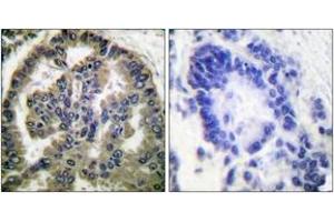 Immunohistochemistry analysis of paraffin-embedded human lung carcinoma tissue, using TGF beta2 Antibody. (TGFB2 抗体  (AA 361-410))