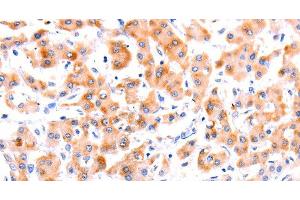 Immunohistochemistry of paraffin-embedded Human liver cancer tissue using Ephrin A1 Polyclonal Antibody at dilution 1:37 (Ephrin A1 抗体)