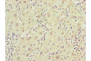 Immunohistochemistry of paraffin-embedded human liver cancer using ABIN7152411 at dilution of 1:100 (FBXO22 抗体  (AA 104-403))