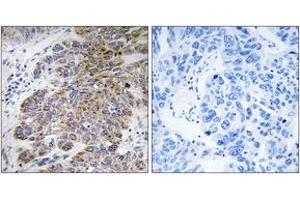 Immunohistochemistry analysis of paraffin-embedded human lung carcinoma tissue, using CHST10 Antibody. (CHST10 抗体  (AA 191-240))