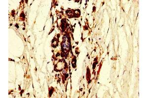 IHC image of ABIN7150454 diluted at 1:300 and staining in paraffin-embedded human breast cancer performed on a Leica BondTM system. (POLR3B 抗体  (AA 831-939))