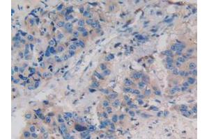 IHC-P analysis of Human Breast Cancer Tissue, with DAB staining. (WNT3A 抗体  (AA 19-352))