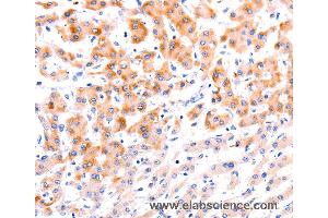 Immunohistochemistry of Human thyroid cancer using EFNA1 Polyclonal Antibody at dilution of 1:37 (Ephrin A1 抗体)