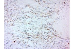Formalin-fixed and paraffin embedded human laryngeal carcinoma labeled with Anti-MMP-2 Polyclonal Antibody, Unconjugated  at 1:200 followed by conjugation to the secondary antibody and DAB staining. (MMP2 抗体  (AA 561-660))