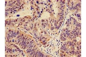 Immunohistochemistry of paraffin-embedded human colon cancer using ABIN7146988 at dilution of 1:100 (CTNND1 抗体  (AA 482-605))