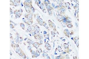 Immunohistochemistry of paraffin-embedded Human breast cancer using SRC Polyclonal Antibody at dilution of 1:100 (40x lens). (Src 抗体)