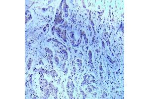 Immunohistochemical analysis of paraffin- embedded human breast carcinoma tissue using ASK1 (Ab-83) Antibody (E022058). (ASK1 抗体)